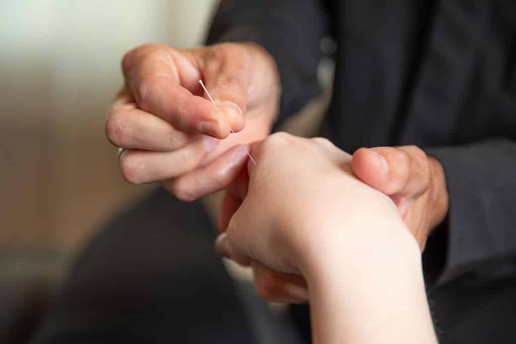 Acupunctuur behandeling